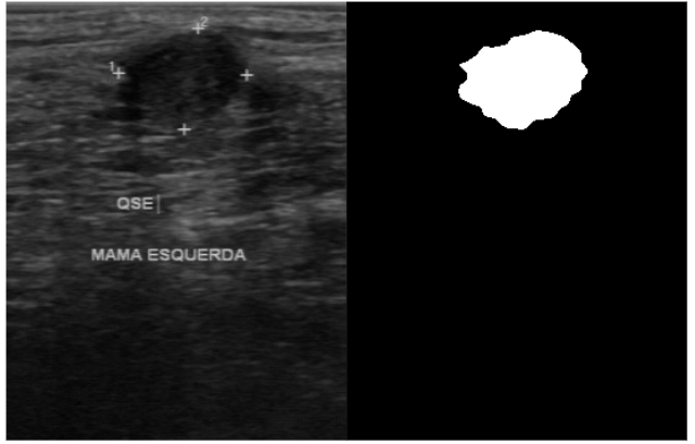 Example from the BUS-BRA dataset showing a breast ultrasound image, its binary tumor segmentation mask, and the mask overlaid on the original image.