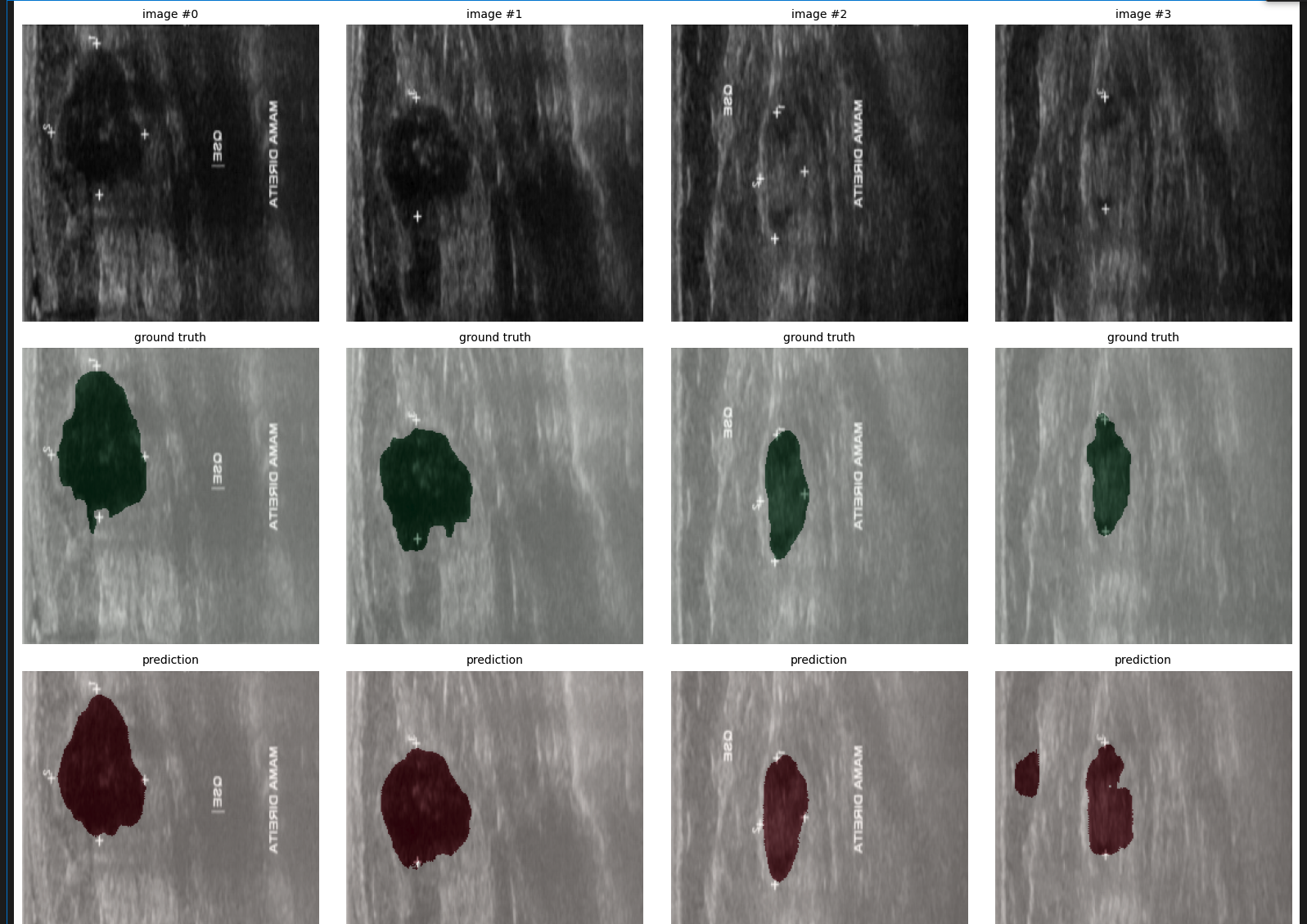 Four-panel visualization showing a representative segmentation result: the original breast ultrasound image, the ground-truth tumor mask, the model’s predicted mask, and the predicted mask overlaid on the original image. The prediction closely matches the annotated tumor boundary.